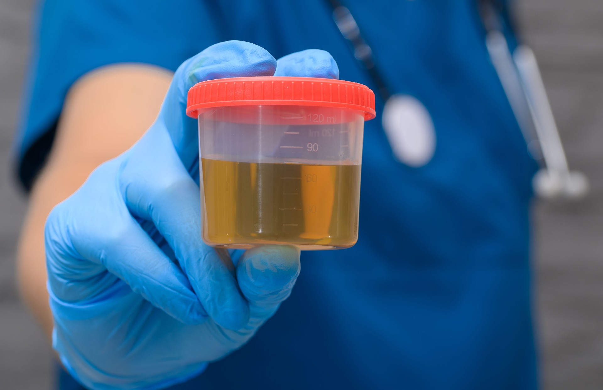Urinalysis, urine culture, close-up of a plastic container with urine